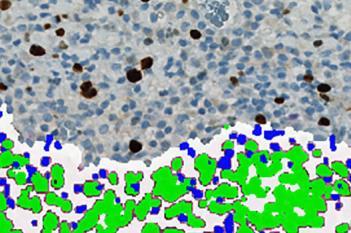 Ki-67+p16, Cervical Cancer