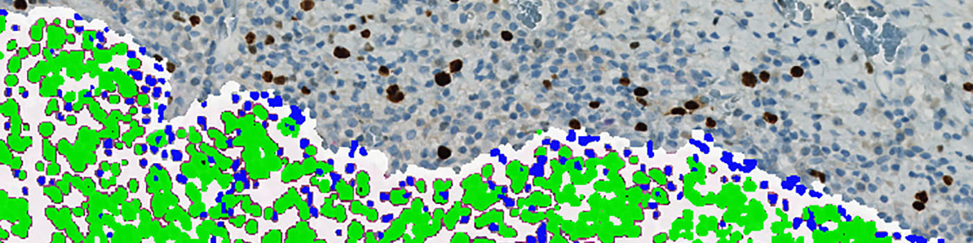 Ki-67+p16, Cervical Cancer