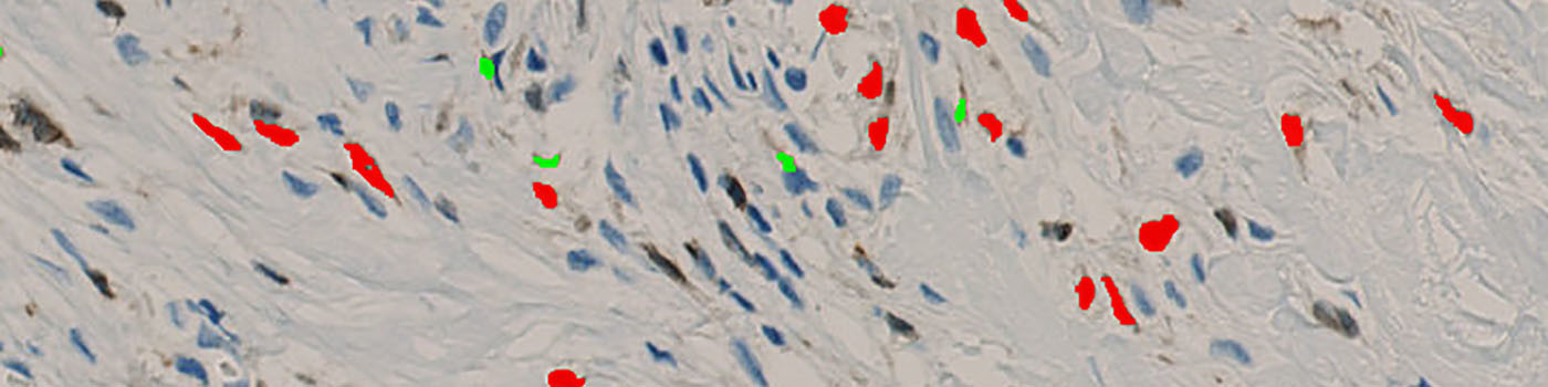 5LO, Arteriosclerosis