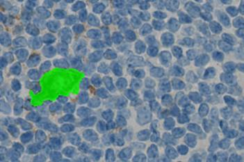 CD15, Hodgkin's Lymphoma