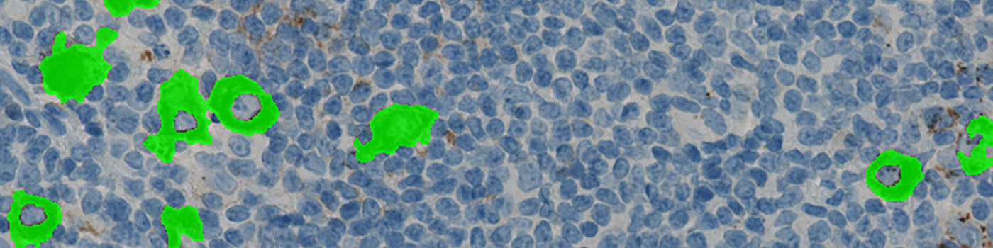 CD15, Hodgkin’s Lymphoma