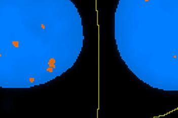 HER2/HER3, Breast Cancer