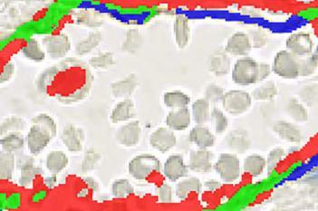 CD31+CD34, Kidney Cancer