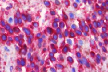 Ki-67+MART1, Melanoma