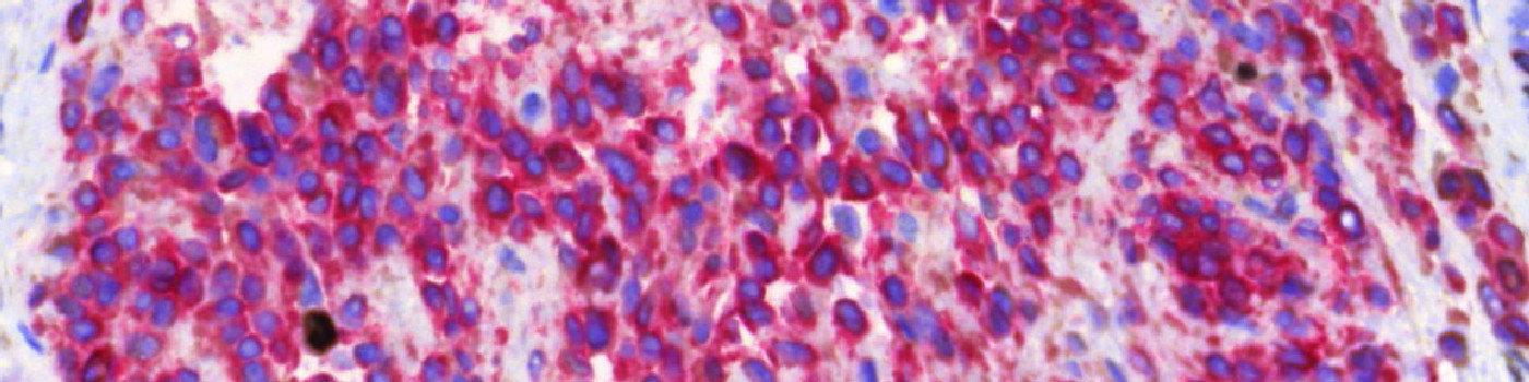 Ki-67+MART1, Melanoma