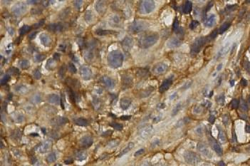 NBCN1, Breast Cancer