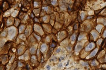 Glut1, Breast/Colon/Lung Cancer