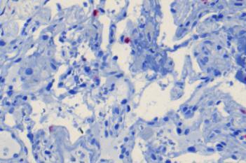 CD3, Lung Transplantation