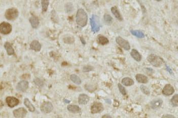 Survivin, Bladder Cancer