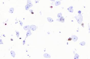 p16+Ki-67, Cervical Cancer, ICC