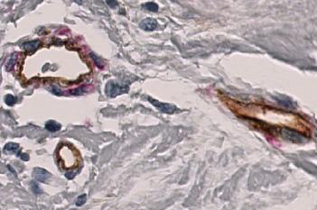 aSMA+Col IV, Breast Cancer