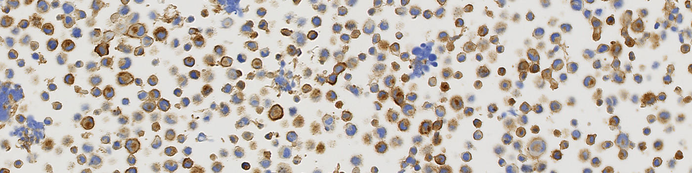 MET, Cell Lines, Cancer