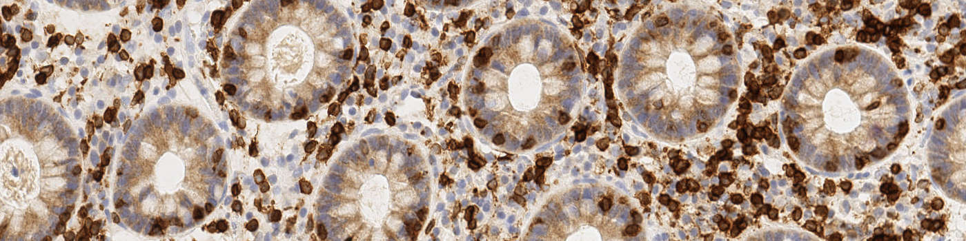 CD3, Lymphocytic Colitis