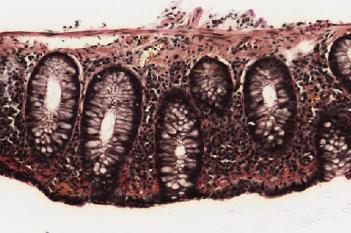Van Gieson, Collagenous Colitis