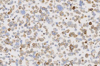 PD-L1, Cell Lines, Cancer