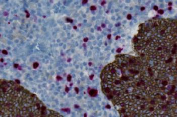 CK5+Ki-67, Neck Cancer