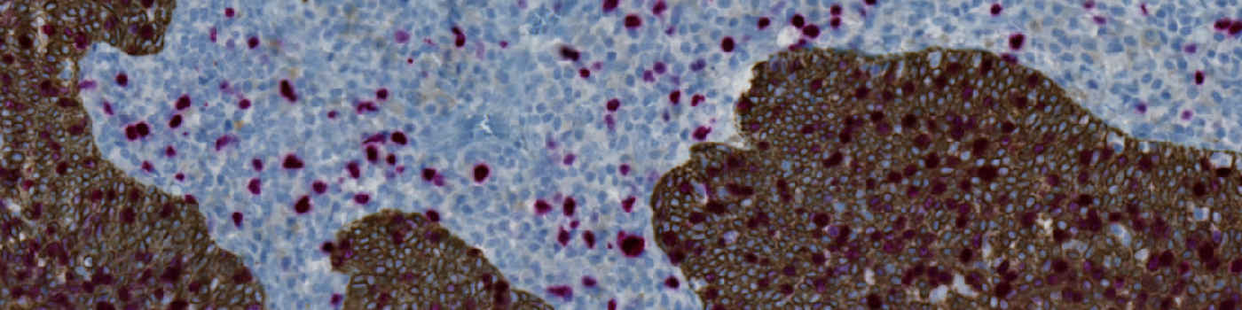 CK5+Ki-67, Neck Cancer