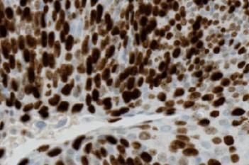 Ki-67 + CK5 VDS, Neck Cancer