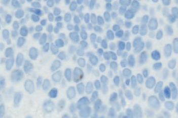 PHH3 + CK5 VDS, Neck Cancer