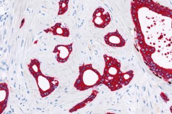 Invasive Tumor Detection (PDS)