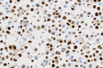 PR, Cell Lines, Cancer