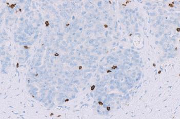 CD8, Ovarian Cancer, TME