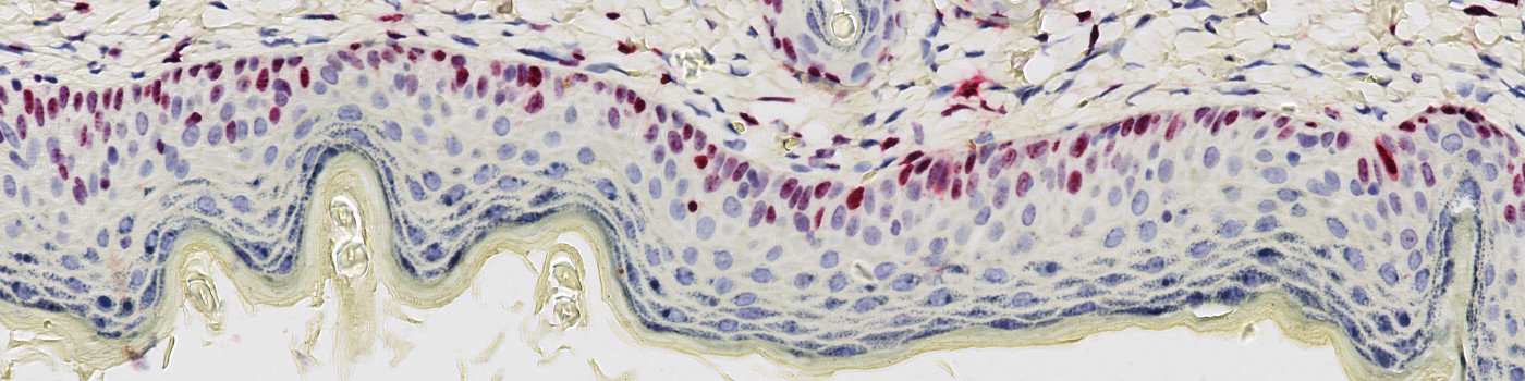 Ki-67, Epidermal Hyperplasia