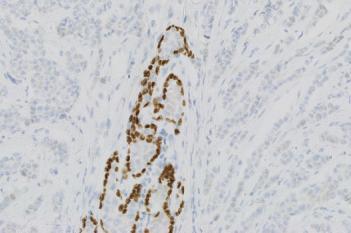 Invasive Tumor Detection (VDS)