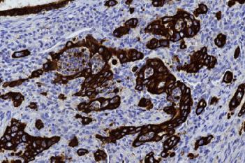 PCK, Tumor Budding, Colorectal Cancer