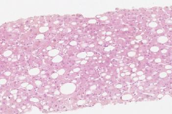 H&E, Liver Steatosis
