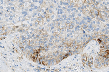 PD-L1, Melanoma, TME