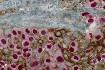 PD-L1+SOX10, Melanoma, TME