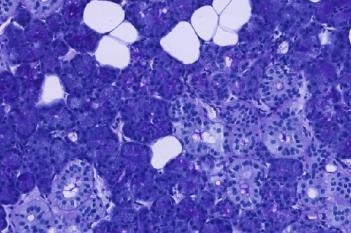 PAS + PCK (VDS), Salivary Gland Tumor