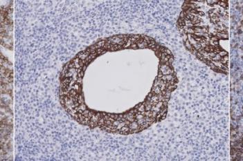 CD3+CD20+CK, Sjögren's Syndrome
