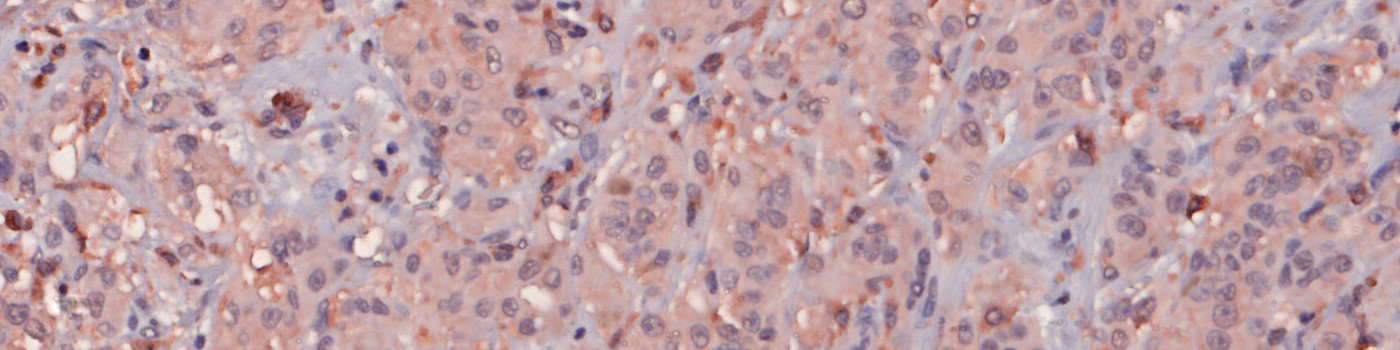 CD74, Melanoma, TME