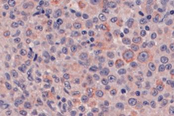 m-PGES1, Melanoma, TME