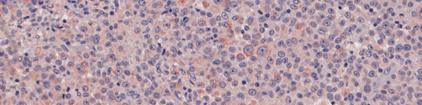 m-PGES1, Melanoma, TME