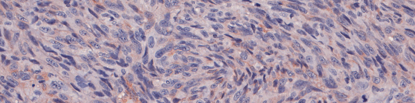 COX2, Melanoma, TME