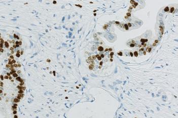 Ki-67, Pancreatic Cancer