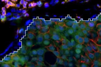 Virtual 8-plex Multiplexing, Breast Cancer, TME