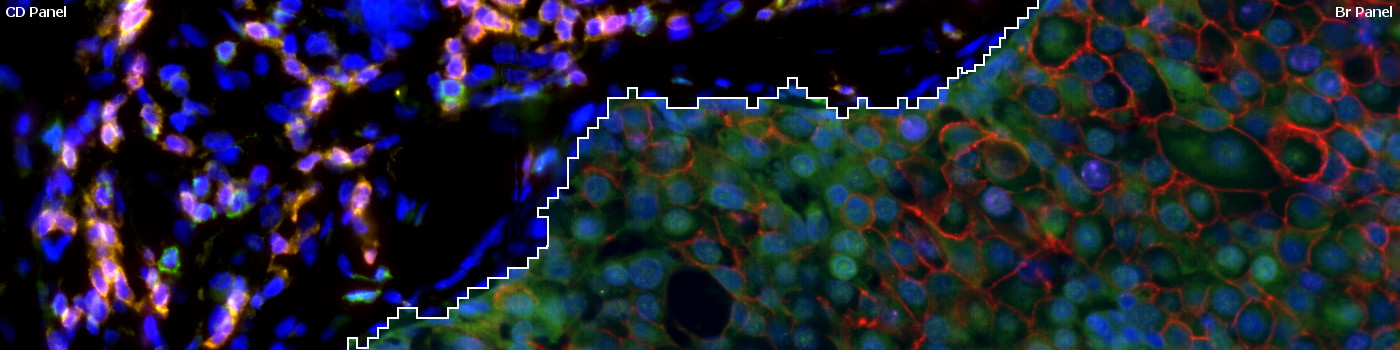 Virtual 8-plex Multiplexing, Breast Cancer, TME