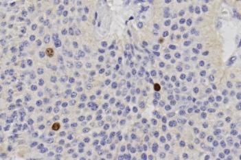 Ki-67, Neuroendocrine Neoplasm