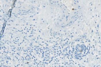 CD57, Ovarian Cancer, TME
