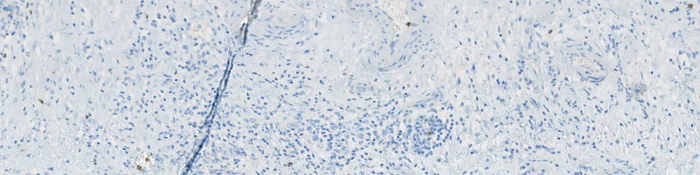 CD57, Ovarian Cancer, TME