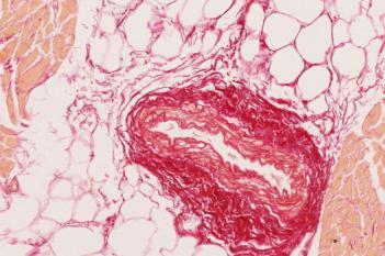 Picrosirius Red, SADS