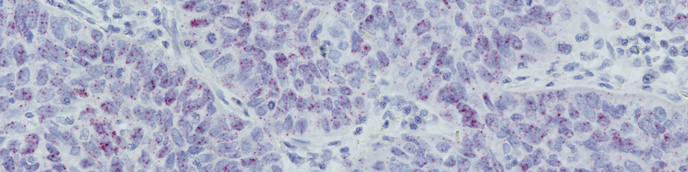 PD-L1 RISH, Lung cancer, TME