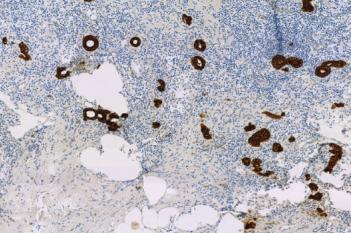 CK, Metastasis Detection