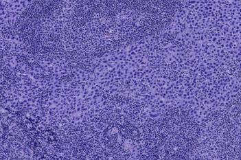 Metastasis Detection, AI