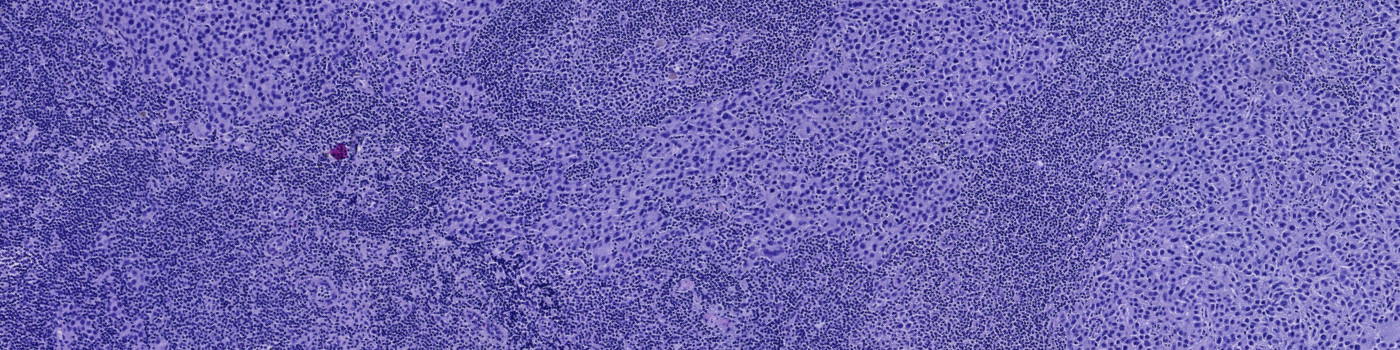 Metastasis Detection, AI