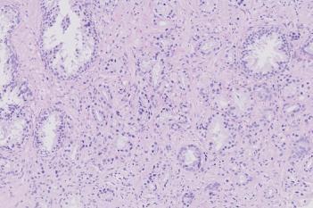 Prostate Cancer Detection, AI